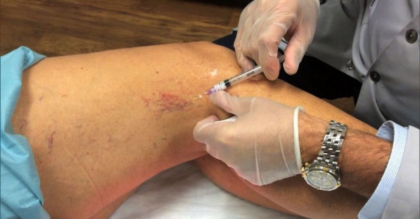 Varislerde lazer ve köpük tedavisi Varislerde lazer ve köpük tedavisi