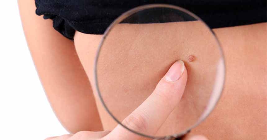 35 yaşından sonra çıkan benler önemsenmeli 35 yaşından sonra çıkan benler önemsenmeli