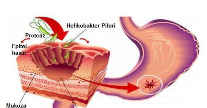 'Helikobakter'e dikkat! 'Helikobakter'e dikkat!