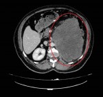 Dünyada ikinci kez Samsun’da rastlandı