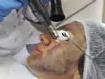 Güneş Lekelerinden “maske Peeling” İle Kurtulun