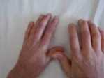 Raynaud Belirtisi Romatizmanın Habercisi Olabilir